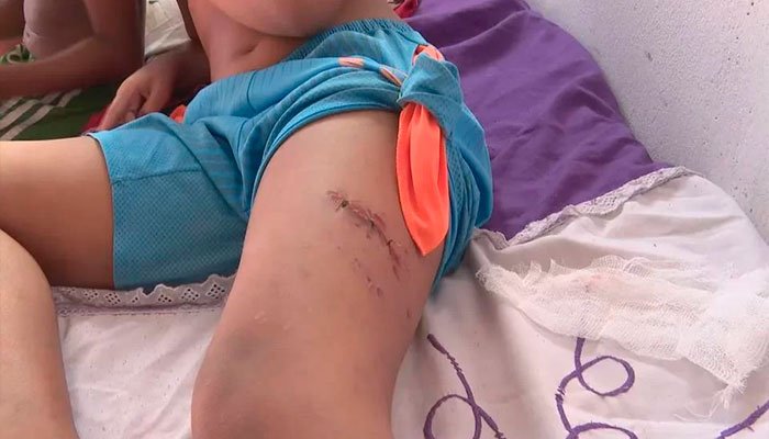 menino de 9 anos é atacado por pit-bull em condomínio residencial
